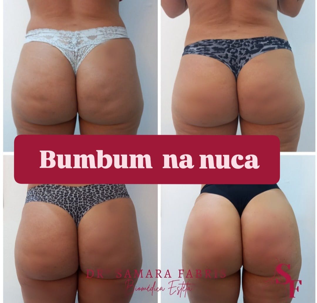 Antes e depois — Bumbum na nuca — antes e depois (Harmonização de Glúteos) realizado pela Dra. Samara Fabris