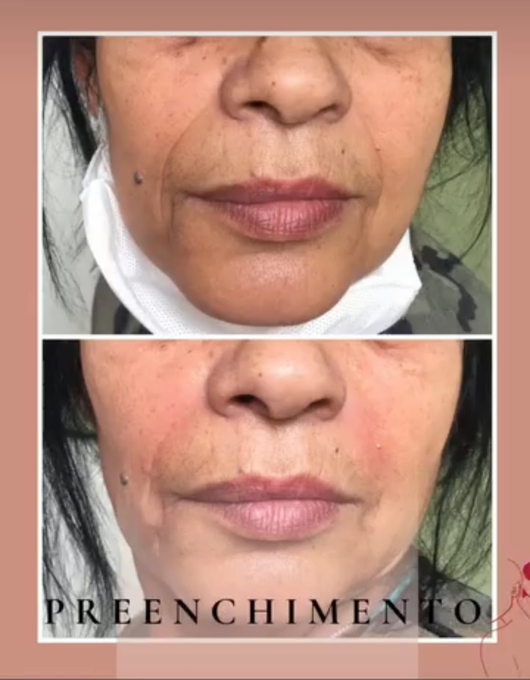 Procedimento de Harmonização Facial