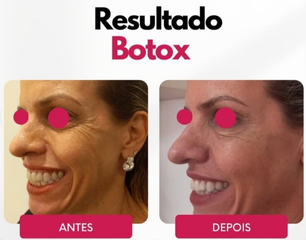 Antes e depois — Sorriso mais leve e rejuvenescido (Botox) realizado pela Dra. Samara Fabris