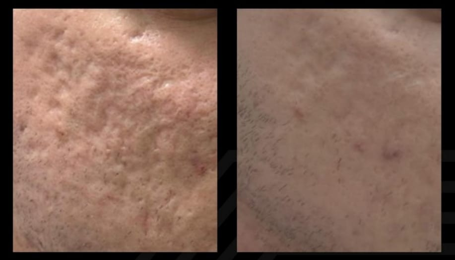 Antes e depois — Cicatrizes de acne suavizadas (CO₂ Fracionado) realizado pela Dra. Samara Fabris