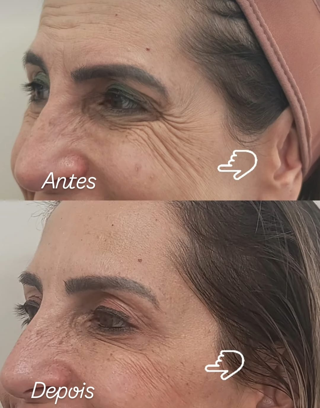 Antes e depois — Olhar descansado e renovado (Rejuvenescimento Periorbital) realizado pela Dra. Samara Fabris