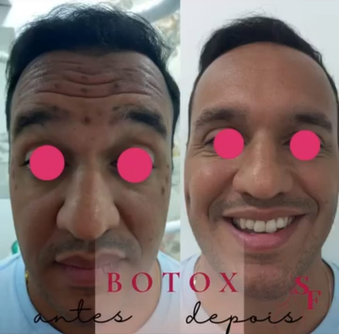 Procedimento de Botox