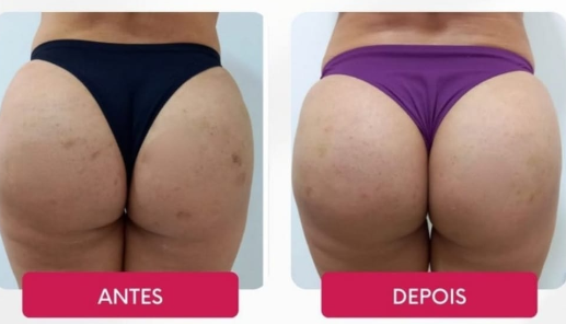 Antes e depois — Pele mais firme e uniforme (Harmonização de Glúteos) realizado pela Dra. Samara Fabris