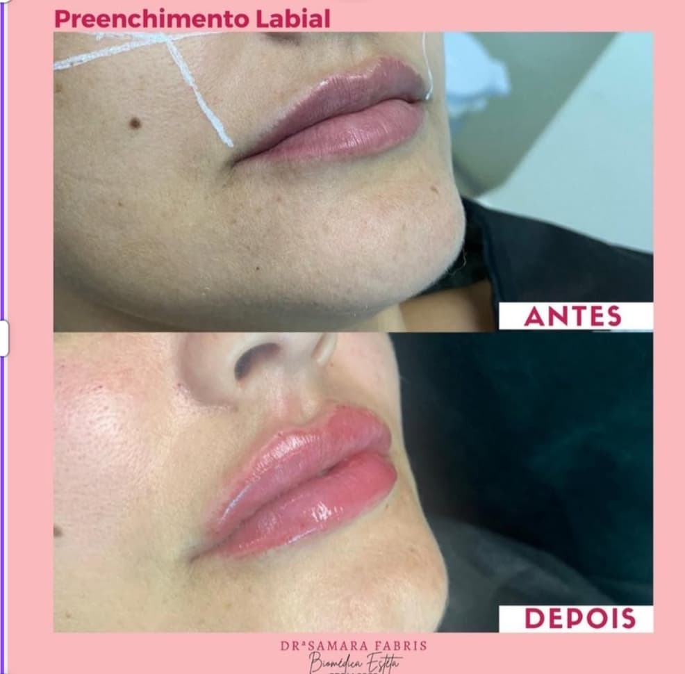 Antes e depois — Lábios naturais e bem desenhados (Preenchimento Labial) realizado pela Dra. Samara Fabris
