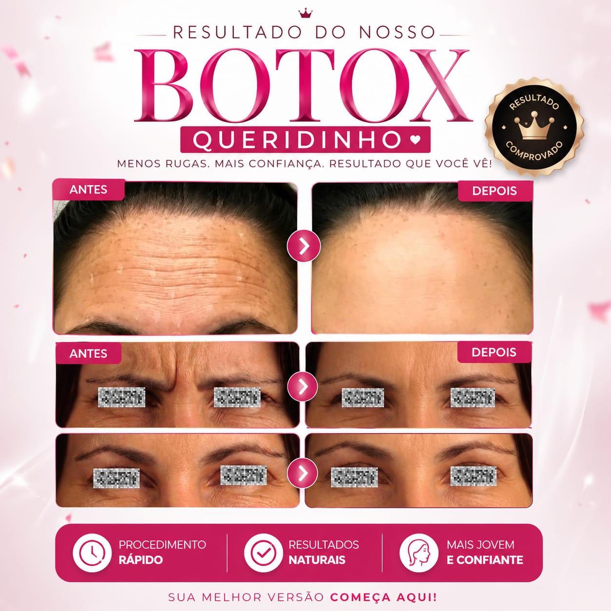 Antes e depois — Adeus rugas de expressão (Botox) realizado pela Dra. Samara Fabris