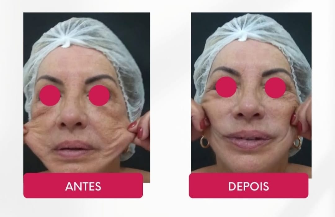 Procedimento de Bioestimuladores