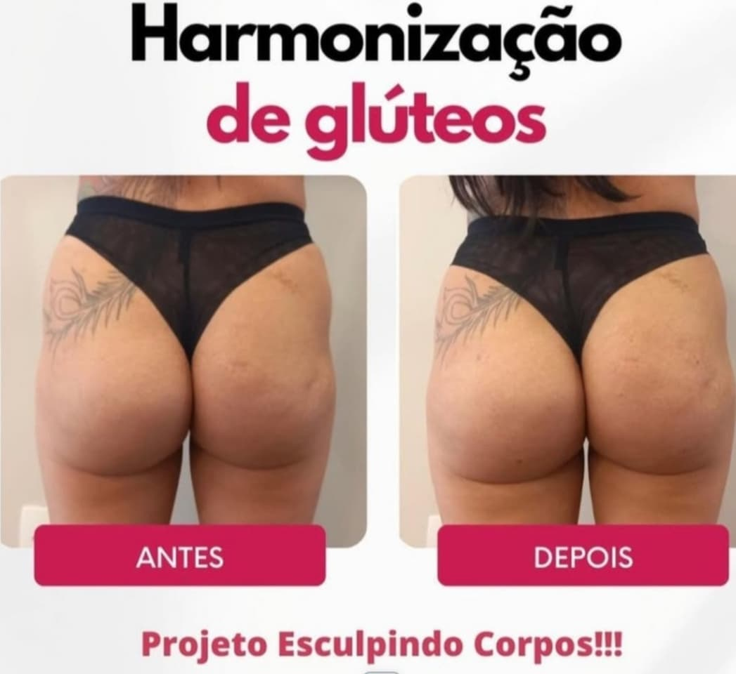 Antes e depois — Projeto esculpindo corpos (Harmonização Corporal) realizado pela Dra. Samara Fabris