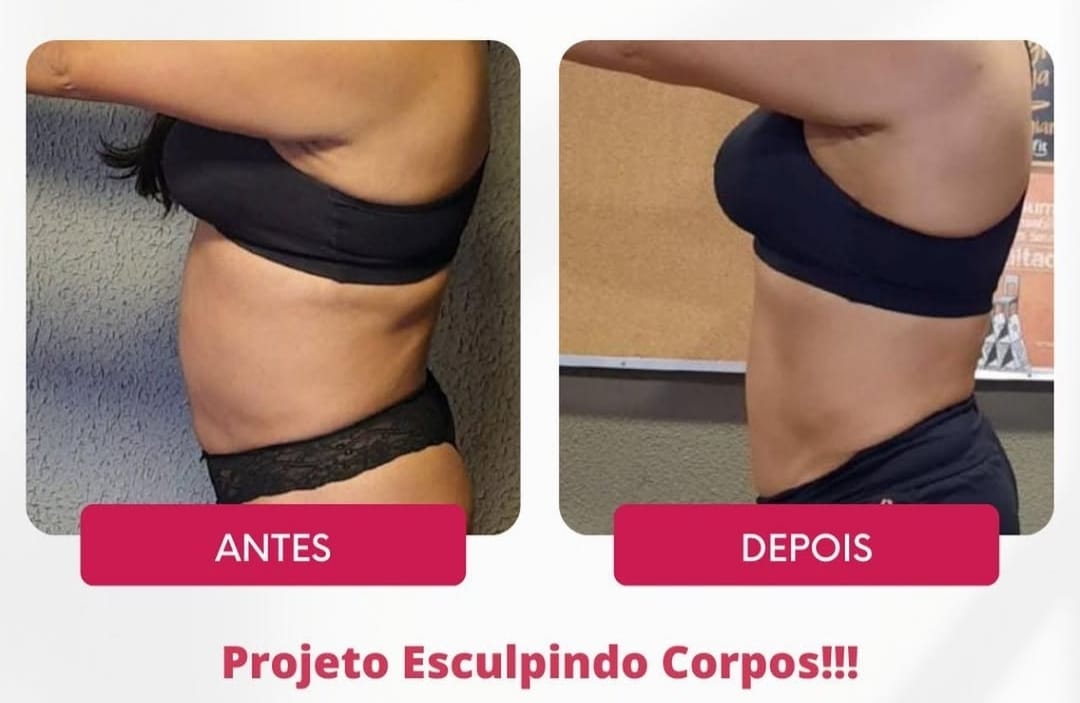 Procedimento de Harmonização Corporal